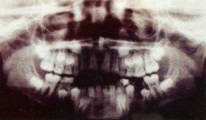 panoramic X-ray of a child ages 10+ showing adult teeth growing in