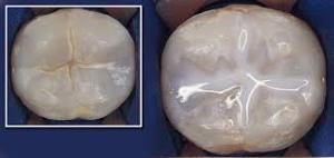 sealant on a molar tooth