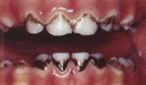 Black Stain on a child's teeth in children ages 2-5