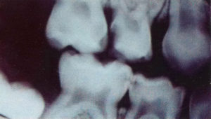 XRay