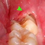 Wisdom Teeth start erupting in children ages 10+