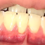 Red Gums in children ages 10+ can be due to hormones