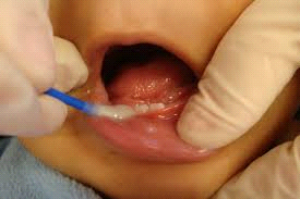 applying iodine to baby teeth in children ages 2-5