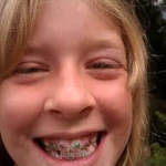 child with braces
