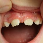 a gap between new adult teeth